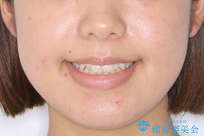 前歯のがたつきを改善してしっかり噛める歯並びへ:インビザライン治療の治療前（顔貌）