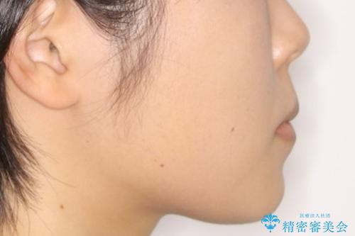 前歯のがたつきとオープンバイト:インビザラインでまとめて治すの治療後(顔貌)