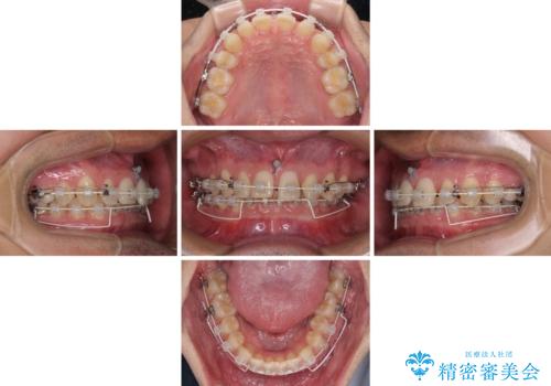 著しいディープバイトと隙間だらけの歯列 の治療中
