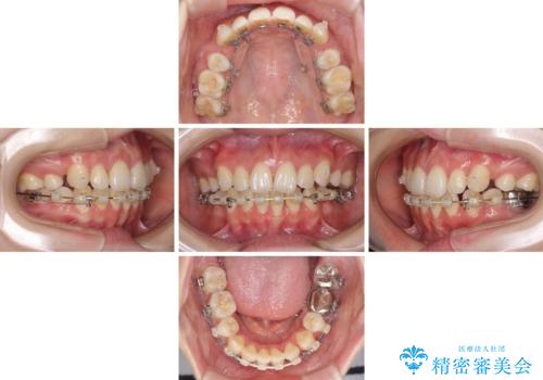 目立たない裏側矯正で突出感を改善 ハーフリンガル矯正の治療中