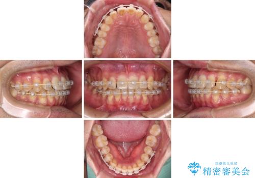 ワイヤー装置での上下前歯の部分矯正の治療中