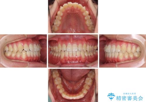 軽微なデコボコを安価に インビザライン・ライトによる矯正治療の治療中