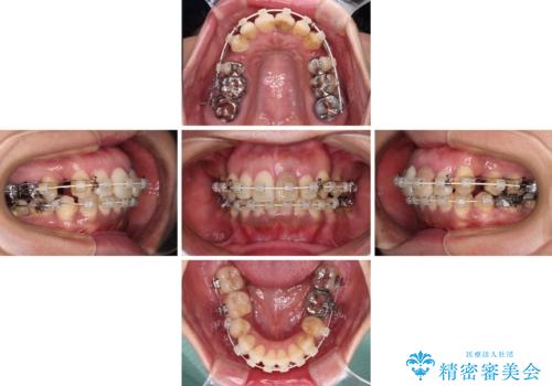 内側に倒れた前歯と口元の突出感 ワイヤー装置での抜歯矯正の治療中