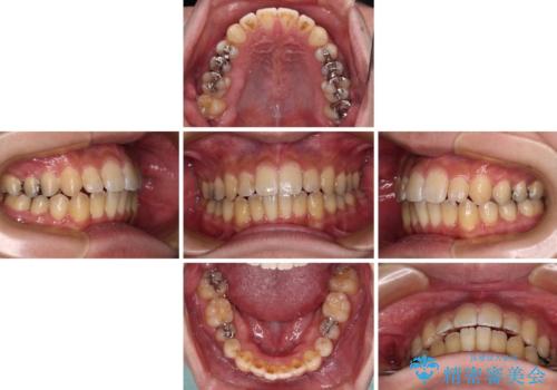 オープンバイトと目立つ銀歯 インビザライン矯正とセラミック修復治療の治療中