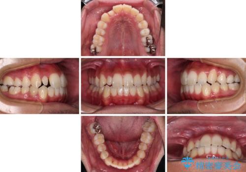 【モニター】左右のクロスバイトをインビザラインできれいに改善の治療中