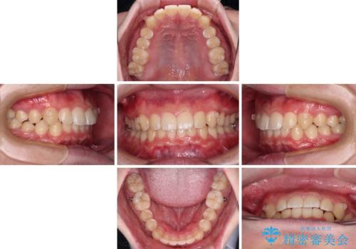 【モニター】斜めに突き出した前歯をインビザラインで改善の治療中