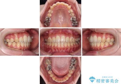 捻れた前歯をインビザラインでスッキリとの治療中