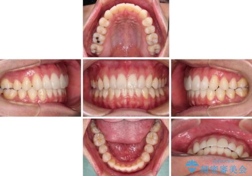 少しでも口元を閉じやすく インビザラインによる前突の解消の治療中