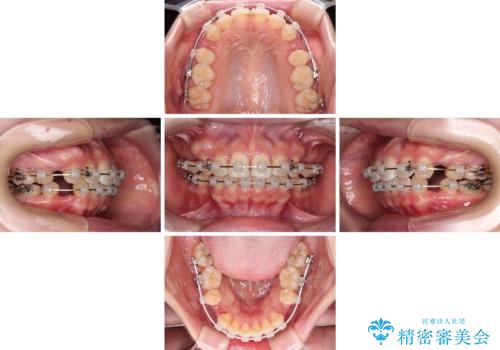 【モニター】短期間で口の閉じにくさを改善 ワイヤー装置での抜歯矯正の治療中