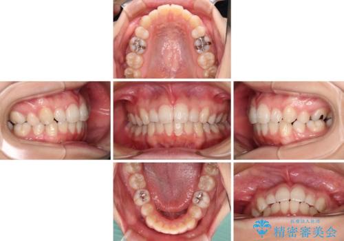 インビザライン・ライトで抜歯矯正の後戻りを解消の治療中