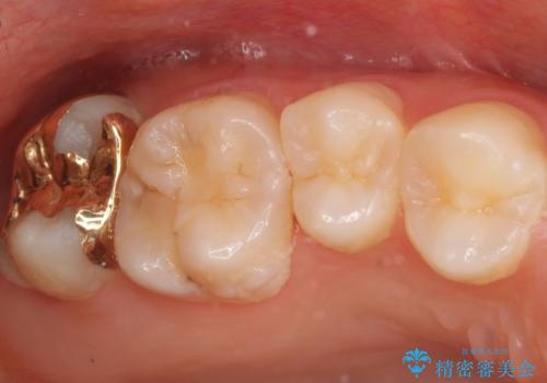 親知らずの手前の歯　抜歯後に適合の良いインレーでの修復処置の症例 治療後