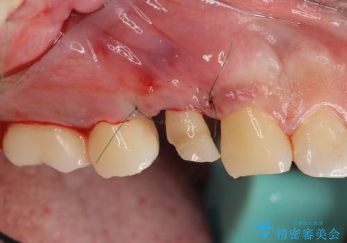 保険治療では抜歯適応になる歯 抜歯せずに保存(エクストリュージョン)の治療中