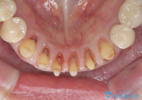 シェーグレン症候群で多発した虫歯　前歯のセラミック治療の治療中