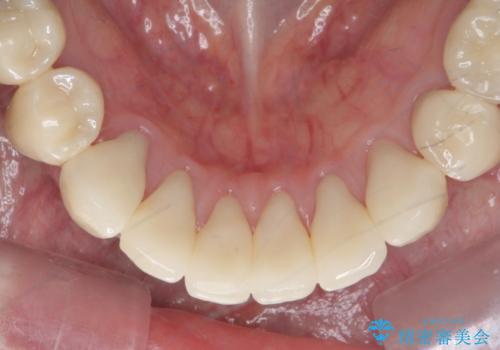 シェーグレン症候群で多発した虫歯　前歯のセラミック治療の治療後