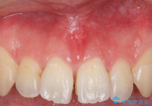 上唇小帯の切除の治療後