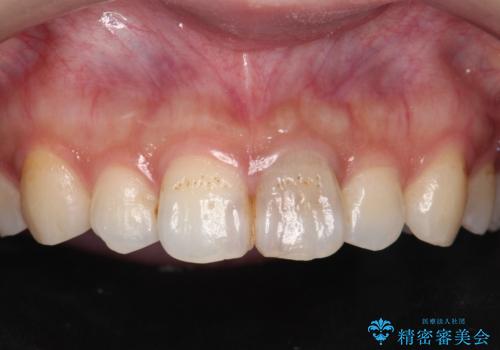 前歯のブリッジ治療の症例 治療前