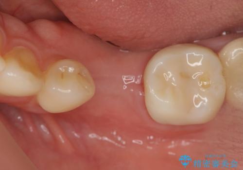 乳歯がぐらついてきた インプラントを用いた機能回復の治療中