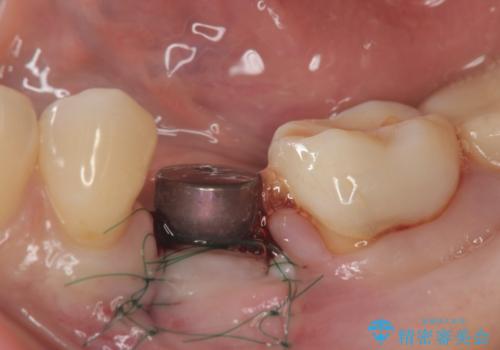 乳歯がぐらついてきた インプラントを用いた機能回復の治療中