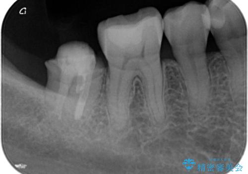 【オールセラミッククラウン】他院で治療した被せものが外れたの治療前