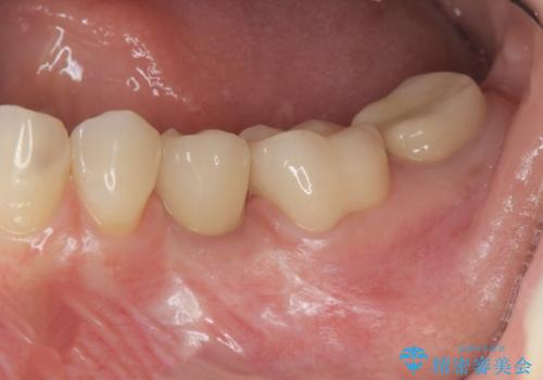乳歯がぐらついてきた インプラントを用いた機能回復の症例 治療後