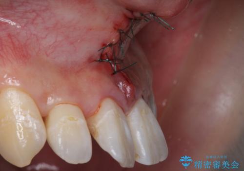 上唇小帯の切除の治療中