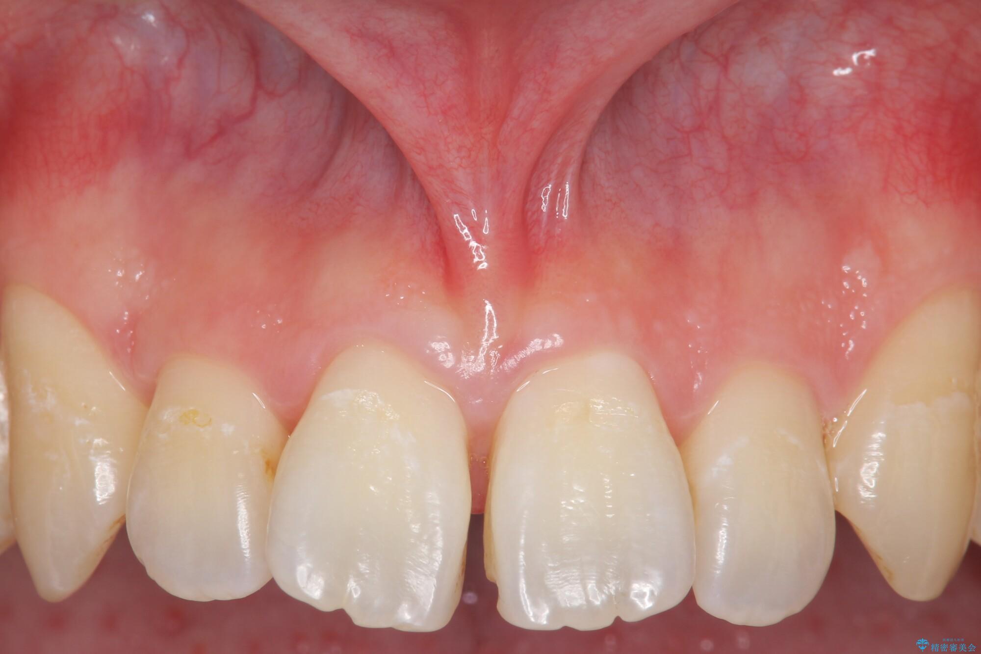 上唇小帯の切除|(医)精密審美会