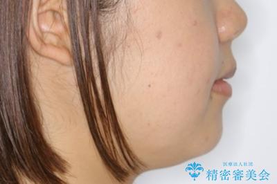 前歯のがたつきを改善してしっかり噛める歯並びへ:インビザライン治療の治療前(顔貌)