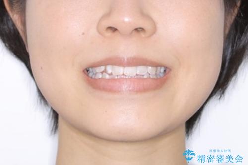 前歯のがたつきとオープンバイト:インビザラインでまとめて治すの治療前（顔貌）
