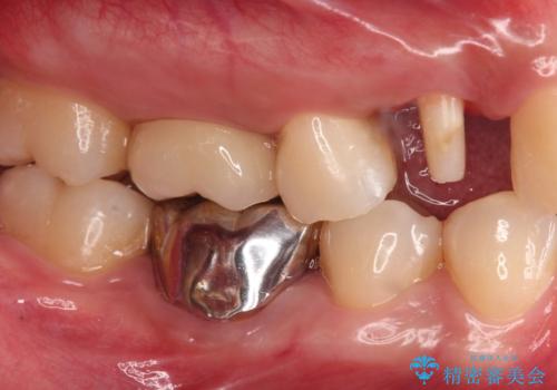 保険治療では抜歯適応になる歯 抜歯せずに保存(エクストリュージョン)の治療中