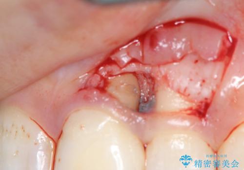 前歯のブリッジ治療の治療中