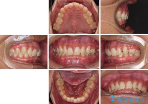 著しいディープバイトと隙間だらけの歯列 の治療前