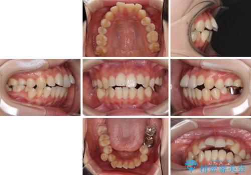 目立たない裏側矯正で突出感を改善 ハーフリンガル矯正の治療前