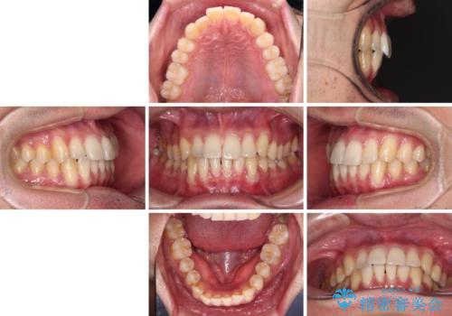 ワイヤー装置での上下前歯の部分矯正の治療前