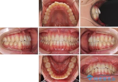 軽微なデコボコを安価に インビザライン・ライトによる矯正治療の治療前