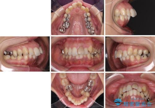 内側に倒れた前歯と口元の突出感 ワイヤー装置での抜歯矯正の治療前