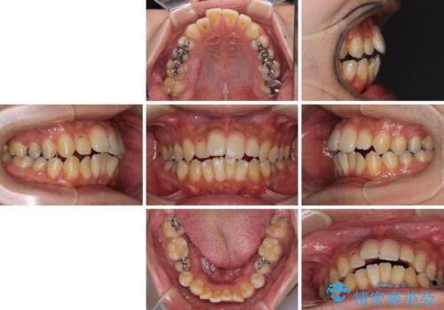 オープンバイトと目立つ銀歯 インビザライン矯正とセラミック修復治療の治療前