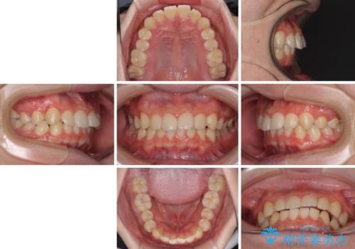 【モニター】斜めに突き出した前歯をインビザラインで改善の治療前