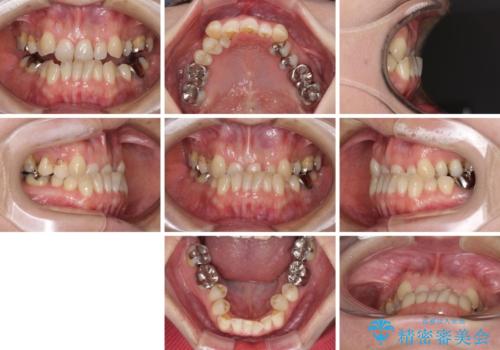 急速拡大装置 前歯の反対咬合をインビザラインで改善の治療前
