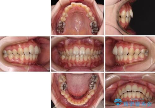 捻れた前歯をインビザラインでスッキリとの治療前