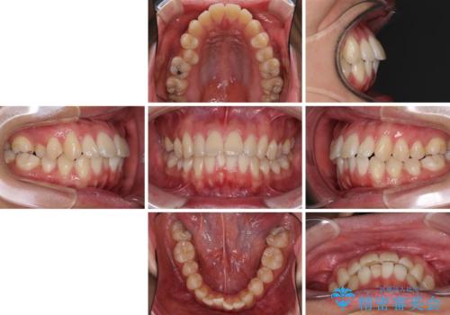 少しでも口元を閉じやすく インビザラインによる前突の解消の治療前