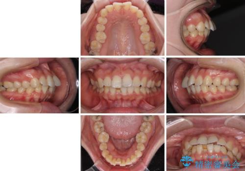 【モニター】短期間で口の閉じにくさを改善 ワイヤー装置での抜歯矯正の治療前