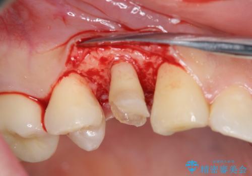 保険治療では抜歯適応になる歯 抜歯せずに保存(エクストリュージョン)の治療中
