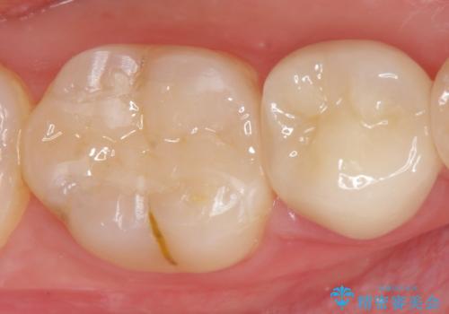 歯が黒くなってきた 虫歯のセラミック治療の治療後