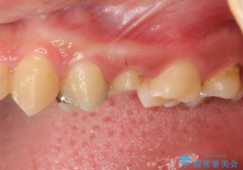 [ 深い虫歯 ]　歯周外科を行い抜歯を回避の治療中