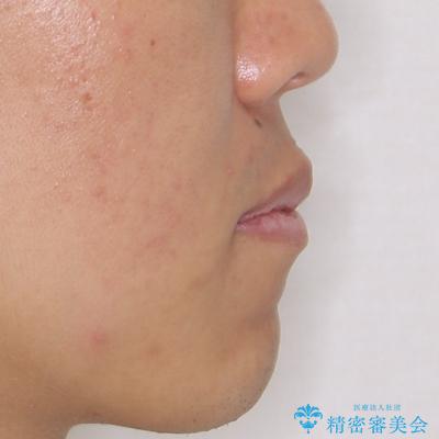 少しでも口元を閉じやすく インビザラインによる前突の解消の治療前(顔貌)