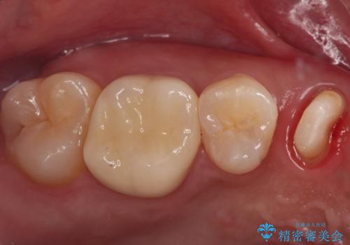 保険治療では抜歯適応になる歯　抜歯せずに保存(エクストリュージョン)の治療中