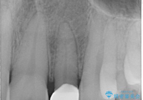 【オールセラミッククラウン】矮小歯の治療の治療後