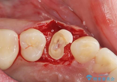 保険治療では抜歯適応になる歯 抜歯せずに保存(エクストリュージョン)の治療中