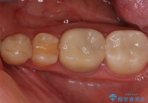矯正終了し、かけたところをセラミックにて治したい。