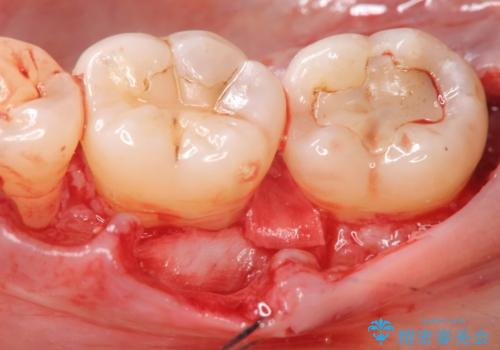 [ 歯周病 ]　歯を残す再生治療の治療前
